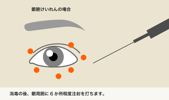 消毒の後、眼周囲に6ヶ所程度駐車を打ちます。