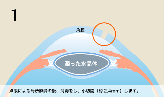 1 点眼による局部麻酔の後、消毒をし、小切開（約2.4mm）します。