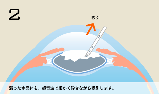 2 濁った水晶体を、超音波で細かく砕きながら吸引します。