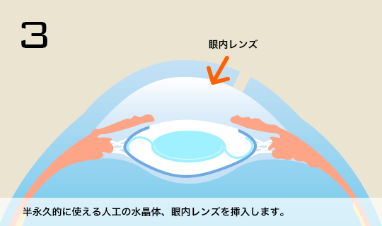 3 半永久的に使える人口水晶体、眼内レンズを挿入します。