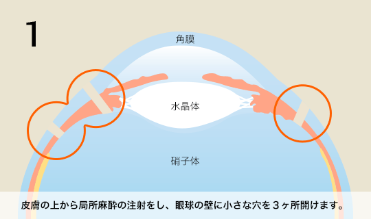 1 皮膚の上から局部麻酔の駐車をし、眼球の壁に小さな穴を3ヶ所開けます。