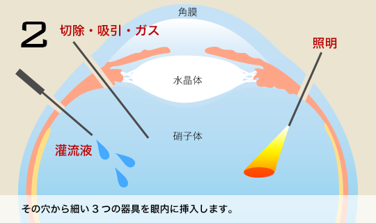 2 その穴から細かい3つの器具を眼内に挿入します。