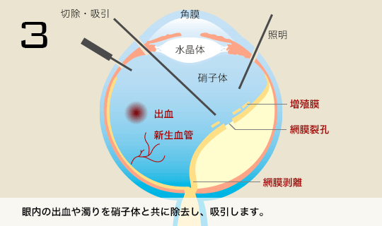 3 眼内の出血や濁りを硝子体と共に除去し、吸引します。