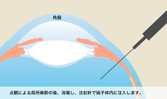 点眼による局所麻酔の後、消毒し、注射針で硝子体内に注入します。